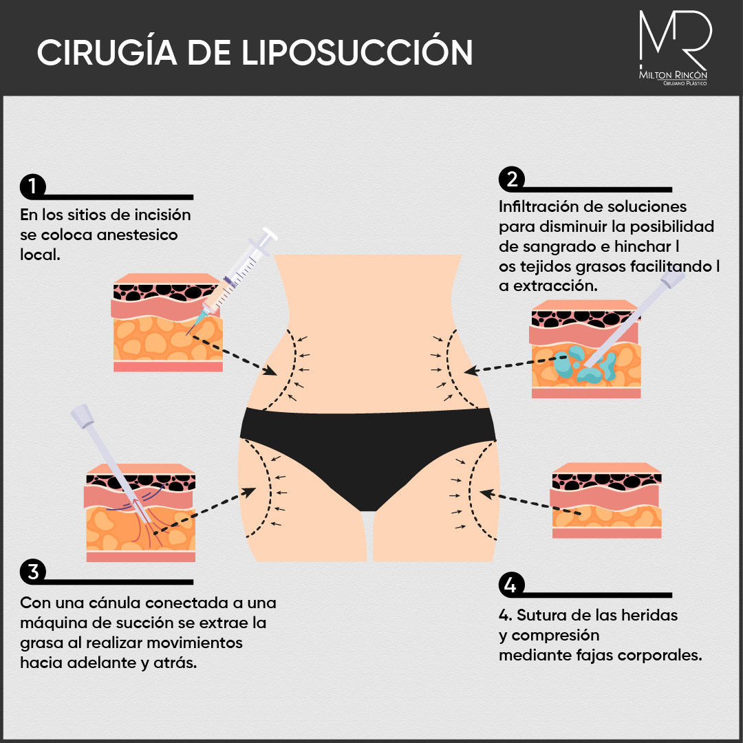 Evolución de abdominoplastia